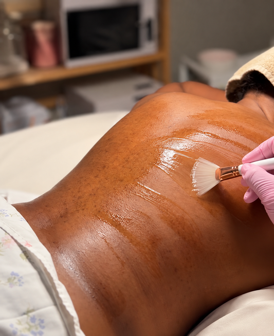 Back Chemical Peel